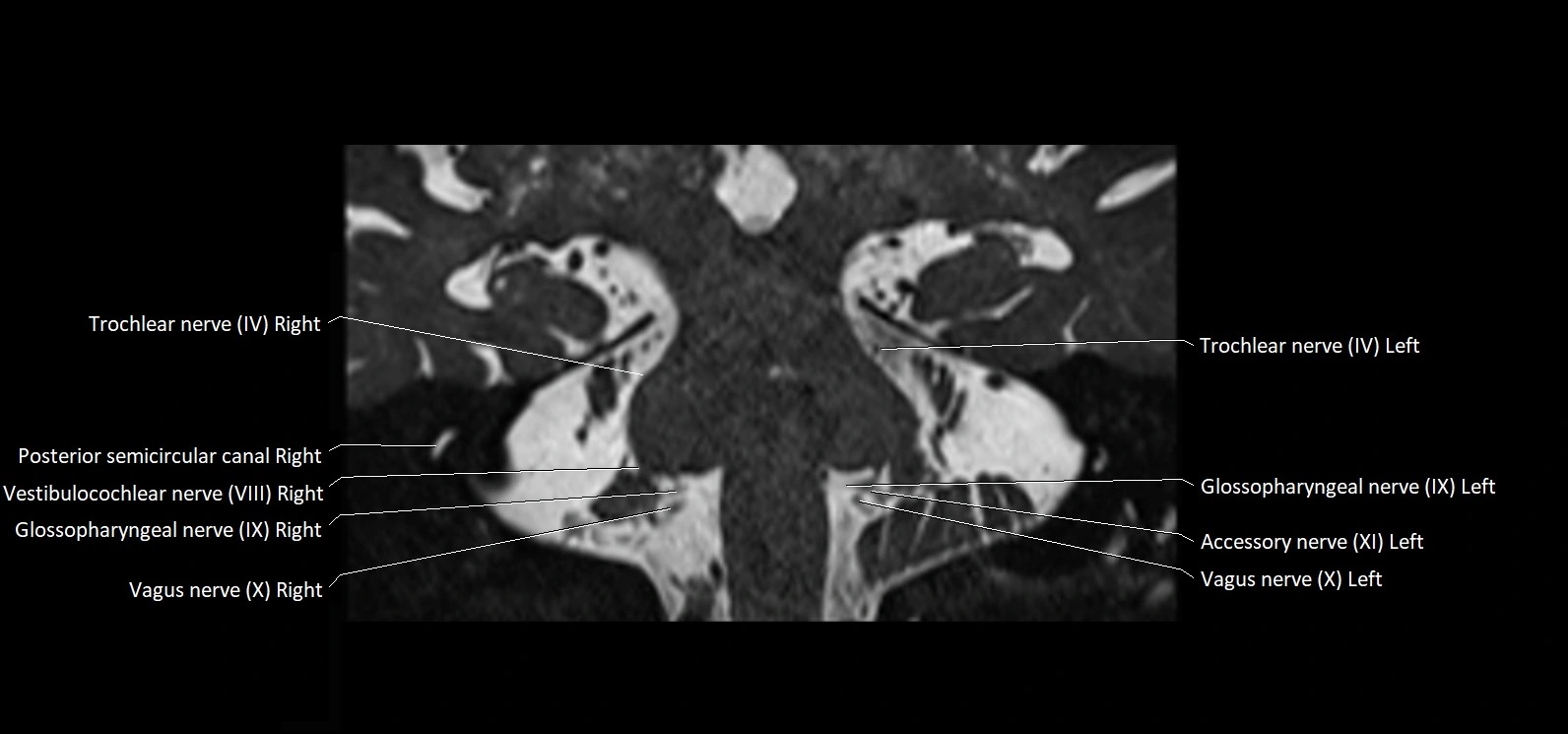 Cranial nerve cross sectional anatomy coronal 3T MRI image 47.webp